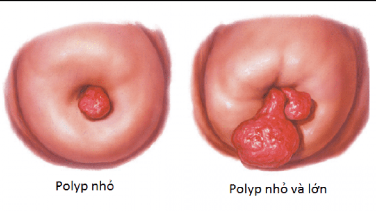 polyp cổ tử cung