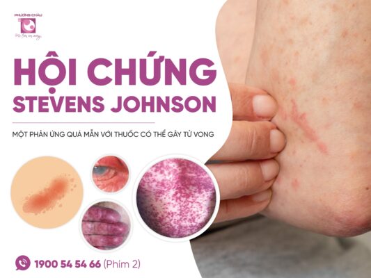 hoi-chung-stevens-johnson